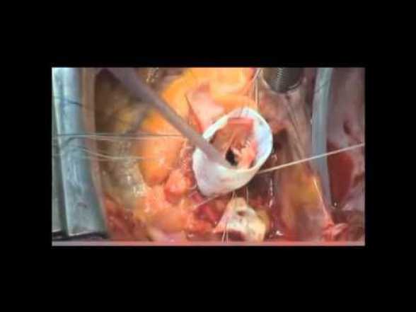 NEW RELEASE. VxPxOxAxAxWxAxMxC vs. TxPxF. A Fairytale full of Apotemnophiliac Moments